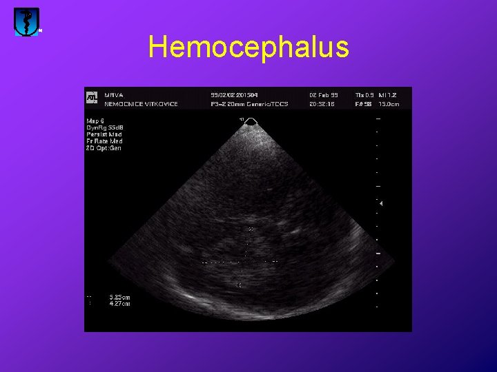 Hemocephalus 