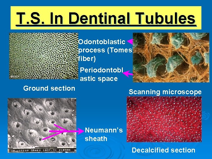 T. S. In Dentinal Tubules Odontoblastic process (Tomes’ fiber) Periodontobl astic space Ground section