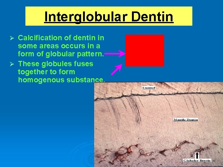 Interglobular Dentin Calcification of dentin in some areas occurs in a form of globular
