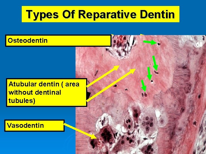 Types Of Reparative Dentin Osteodentin Atubular dentin ( area without dentinal tubules) Vasodentin 