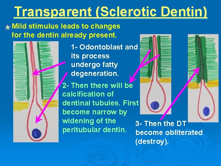 Transparent (Sclerotic Dentin) Mild stimulus leads to changes for the dentin already present. 1