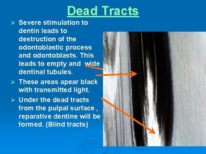 Dead Tracts Severe stimulation to dentin leads to destruction of the odontoblastic process and