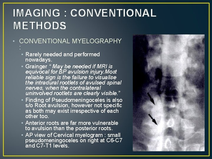IMAGING : CONVENTIONAL METHODS • CONVENTIONAL MYELOGRAPHY : • Rarely needed and performed nowadays.