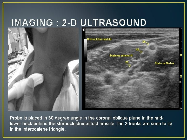 IMAGING : 2 -D ULTRASOUND Probe is placed in 30 degree angle in the