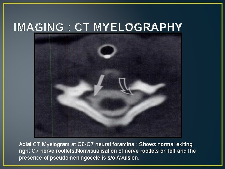 IMAGING : CT MYELOGRAPHY Axial CT Myelogram at C 6 -C 7 neural foramina