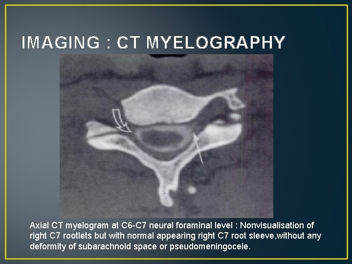 IMAGING : CT MYELOGRAPHY Axial CT myelogram at C 6 -C 7 neural foraminal