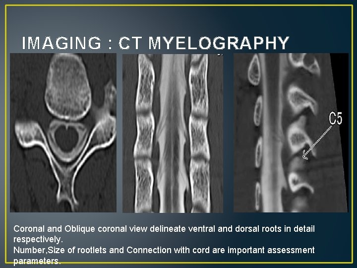 IMAGING : CT MYELOGRAPHY Coronal and Oblique coronal view delineate ventral and dorsal roots