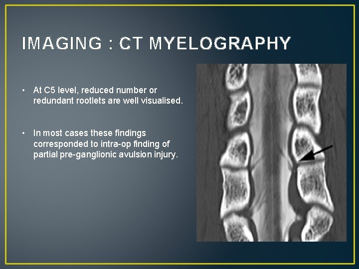 IMAGING : CT MYELOGRAPHY • At C 5 level, reduced number or redundant rootlets