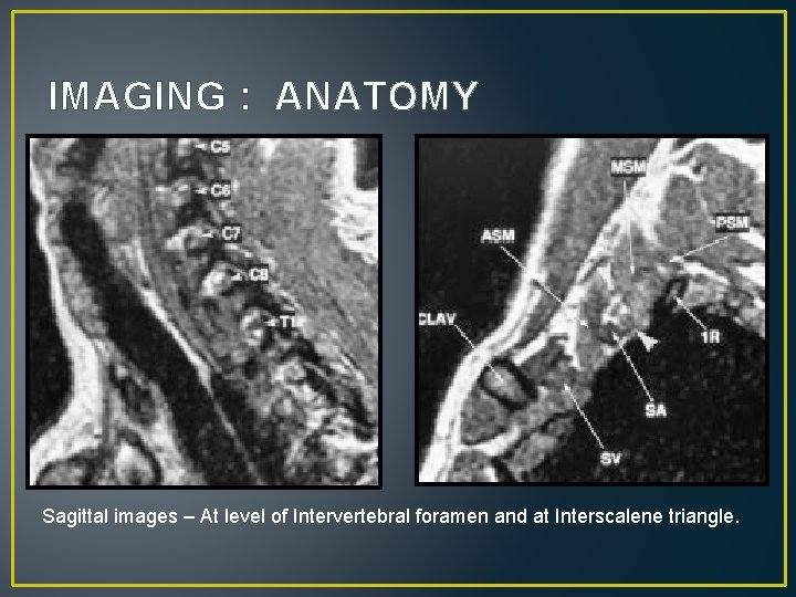 IMAGING : ANATOMY Sagittal images – At level of Intervertebral foramen and at Interscalene