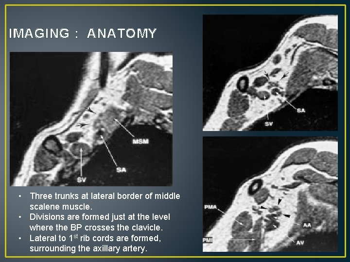 IMAGING : ANATOMY • Three trunks at lateral border of middle scalene muscle. •