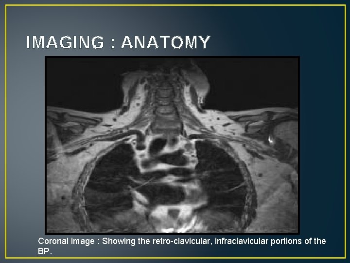 IMAGING : ANATOMY Coronal image : Showing the retro-clavicular, infraclavicular portions of the BP.