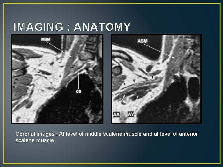 IMAGING : ANATOMY Coronal images : At level of middle scalene muscle and at