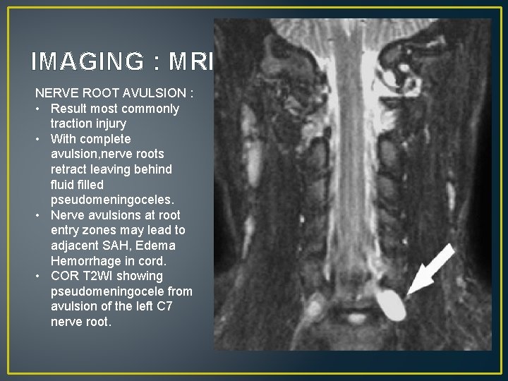 IMAGING : MRI NERVE ROOT AVULSION : • Result most commonly traction injury •