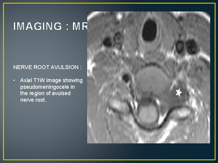 IMAGING : MRI NERVE ROOT AVULSION : • Axial T 1 W image showing