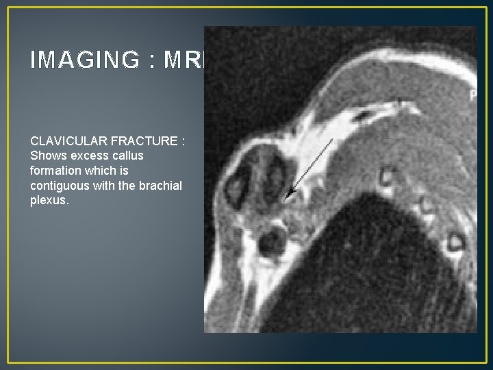 IMAGING : MRI CLAVICULAR FRACTURE : Shows excess callus formation which is contiguous with