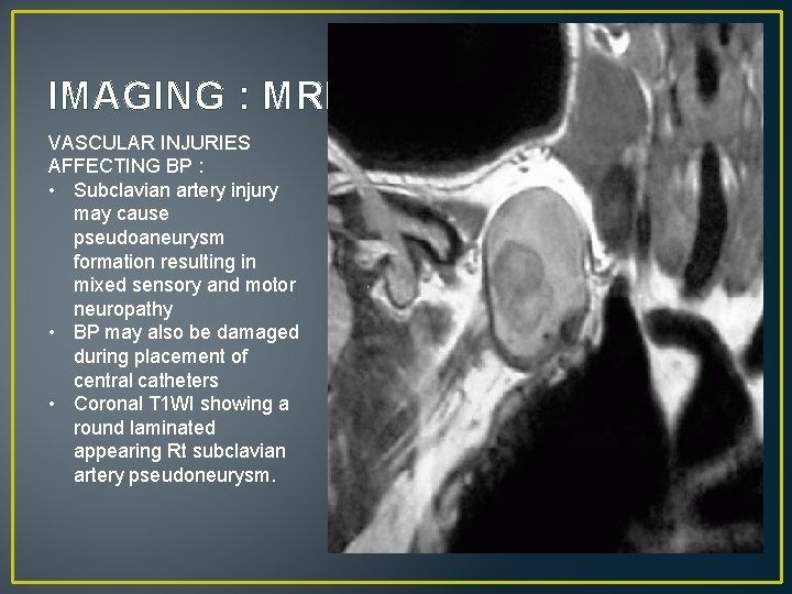 IMAGING : MRI VASCULAR INJURIES AFFECTING BP : • Subclavian artery injury may cause