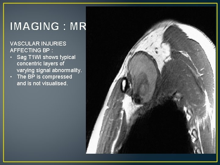 IMAGING : MRI VASCULAR INJURIES AFFECTING BP : • Sag T 1 WI shows
