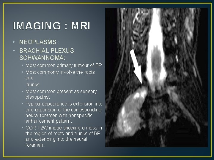 IMAGING : MRI • NEOPLASMS : • BRACHIAL PLEXUS SCHWANNOMA: • Most common primary