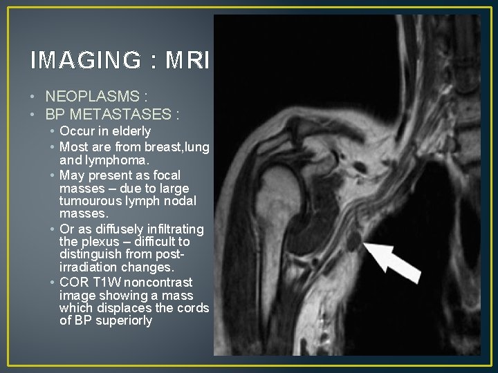 IMAGING : MRI • NEOPLASMS : • BP METASTASES : • Occur in elderly