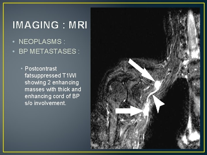 IMAGING : MRI • NEOPLASMS : • BP METASTASES : • Postcontrast fatsuppressed T