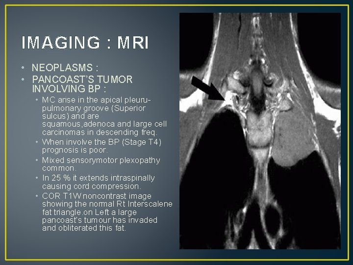 IMAGING : MRI • NEOPLASMS : • PANCOAST’S TUMOR INVOLVING BP : • MC