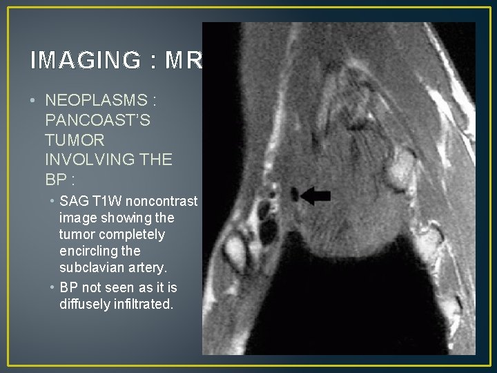 IMAGING : MRI • NEOPLASMS : PANCOAST’S TUMOR INVOLVING THE BP : • SAG