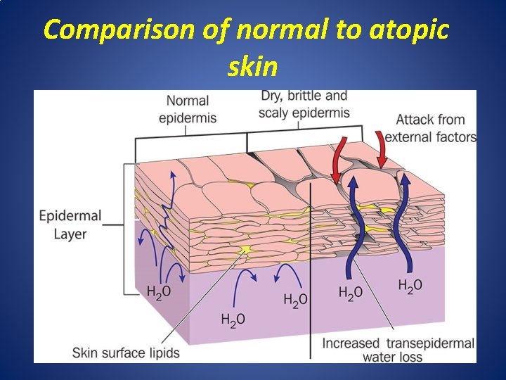 Comparison of normal to atopic skin 