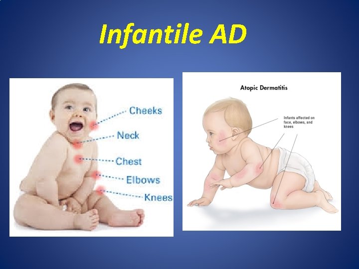 Infantile AD 