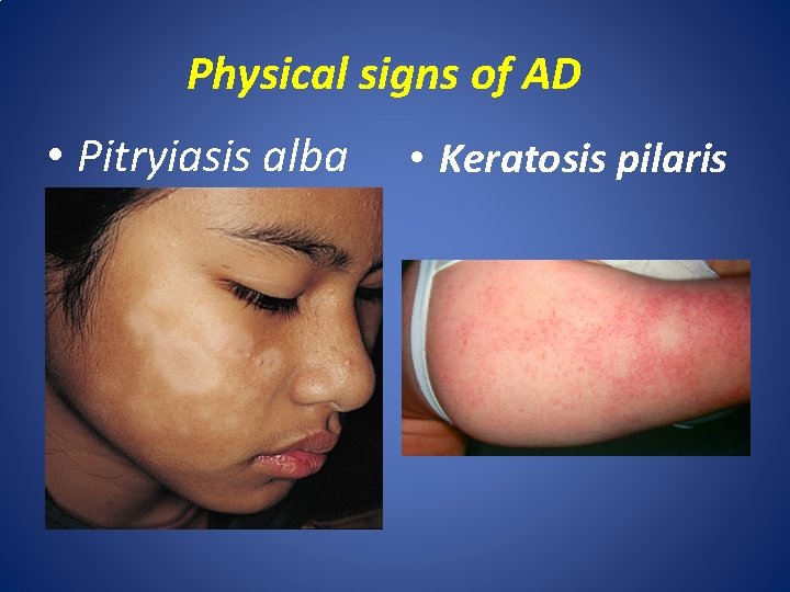 Physical signs of AD • Pitryiasis alba • Keratosis pilaris 