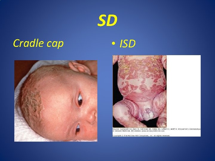 SD Cradle cap • ISD 