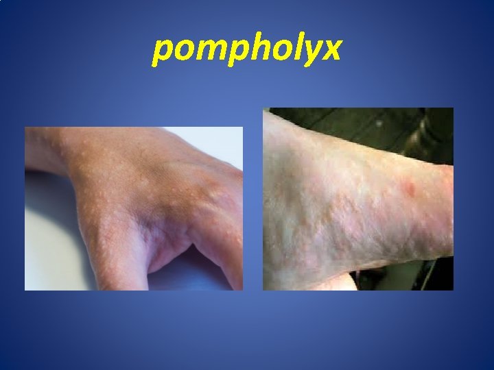 pompholyx 