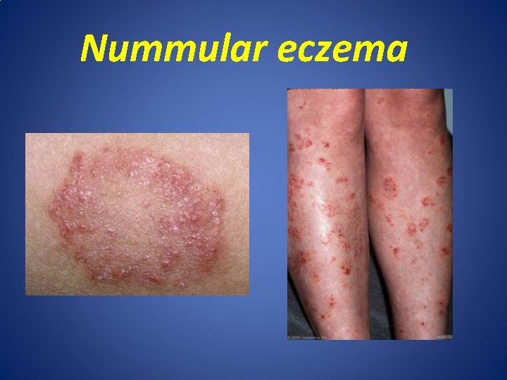 Nummular eczema 