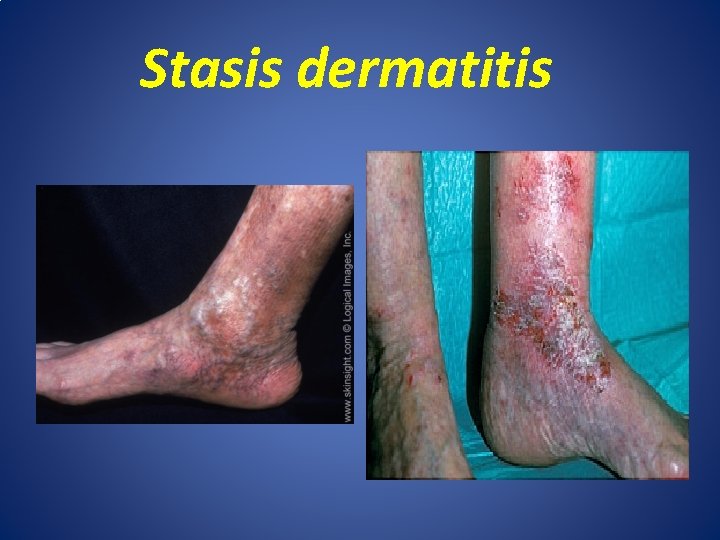 Stasis dermatitis 