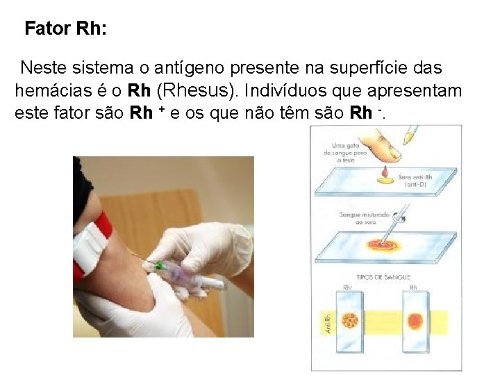 Fator Rh: Neste sistema o antígeno presente na superfície das hemácias é o Rh