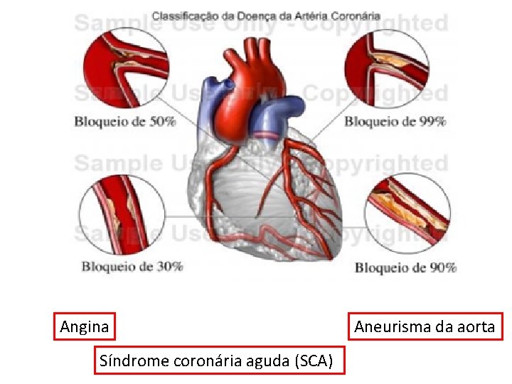 Angina Síndrome coronária aguda (SCA) Aneurisma da aorta 