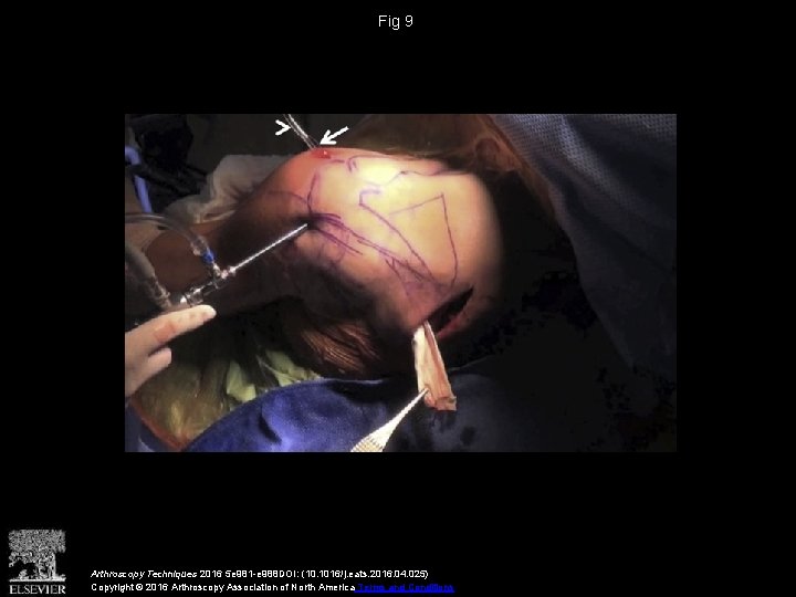 Fig 9 Arthroscopy Techniques 2016 5 e 981 -e 988 DOI: (10. 1016/j. eats.
