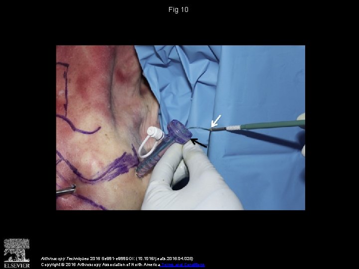 Fig 10 Arthroscopy Techniques 2016 5 e 981 -e 988 DOI: (10. 1016/j. eats.