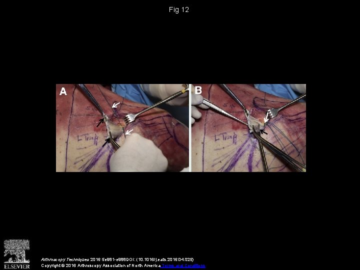 Fig 12 Arthroscopy Techniques 2016 5 e 981 -e 988 DOI: (10. 1016/j. eats.