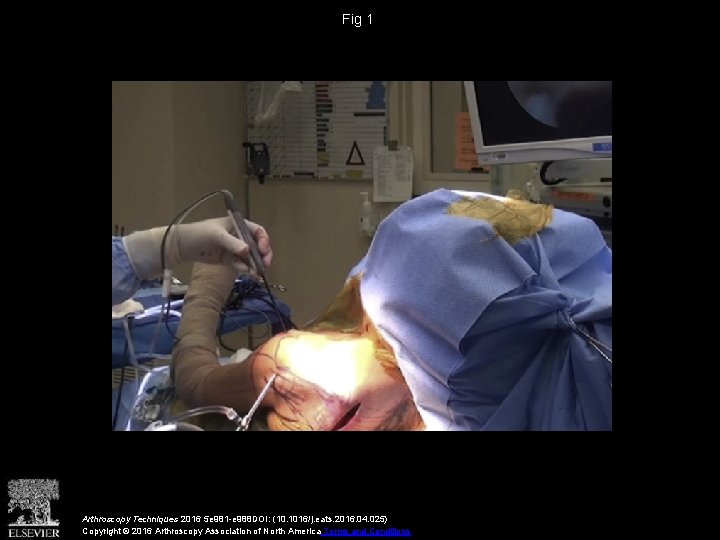 Fig 1 Arthroscopy Techniques 2016 5 e 981 -e 988 DOI: (10. 1016/j. eats.