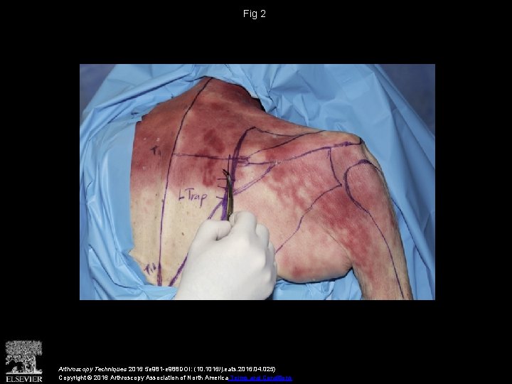 Fig 2 Arthroscopy Techniques 2016 5 e 981 -e 988 DOI: (10. 1016/j. eats.