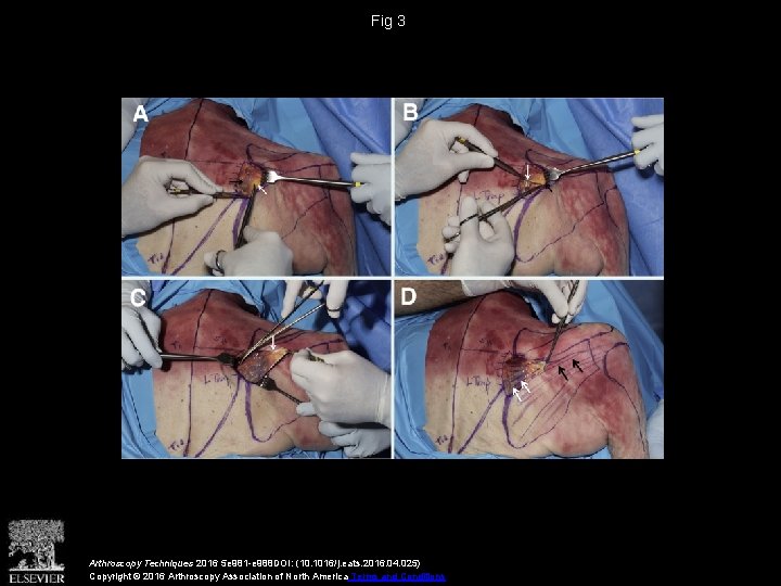 Fig 3 Arthroscopy Techniques 2016 5 e 981 -e 988 DOI: (10. 1016/j. eats.