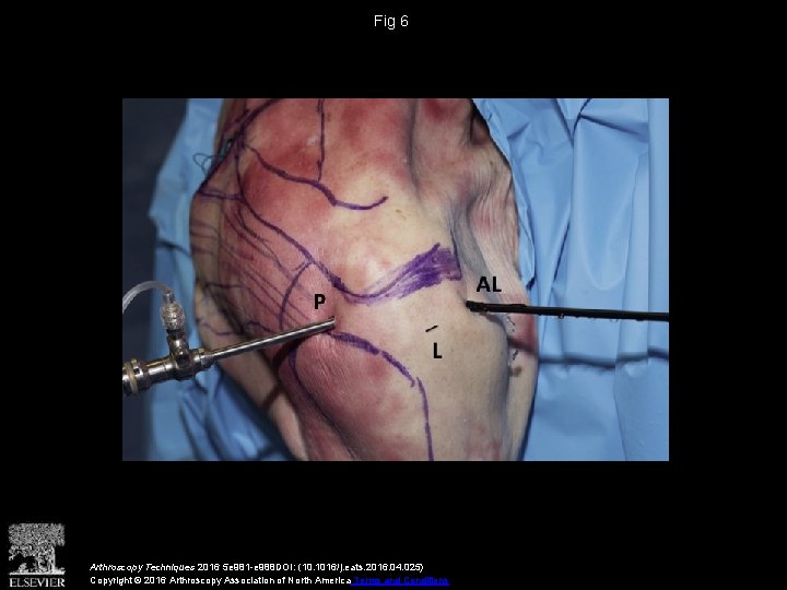 Fig 6 Arthroscopy Techniques 2016 5 e 981 -e 988 DOI: (10. 1016/j. eats.