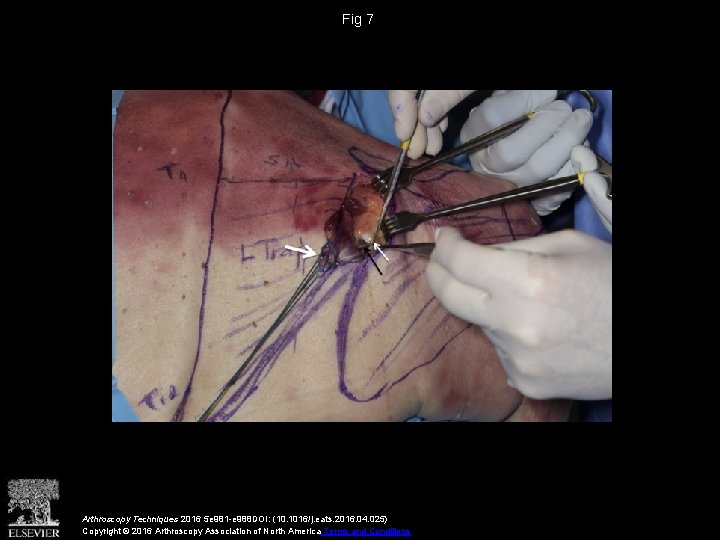 Fig 7 Arthroscopy Techniques 2016 5 e 981 -e 988 DOI: (10. 1016/j. eats.