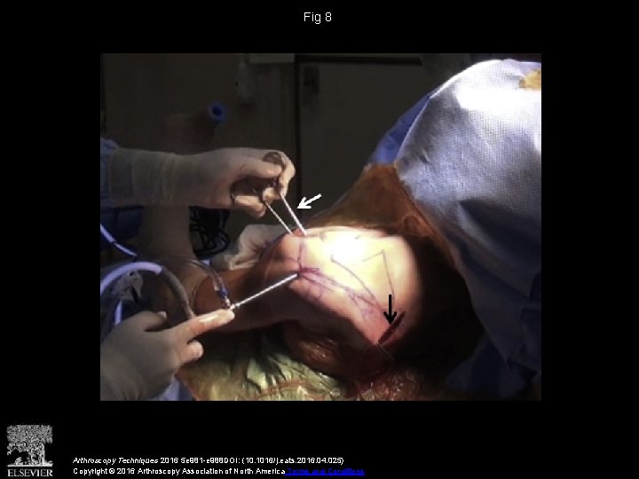 Fig 8 Arthroscopy Techniques 2016 5 e 981 -e 988 DOI: (10. 1016/j. eats.