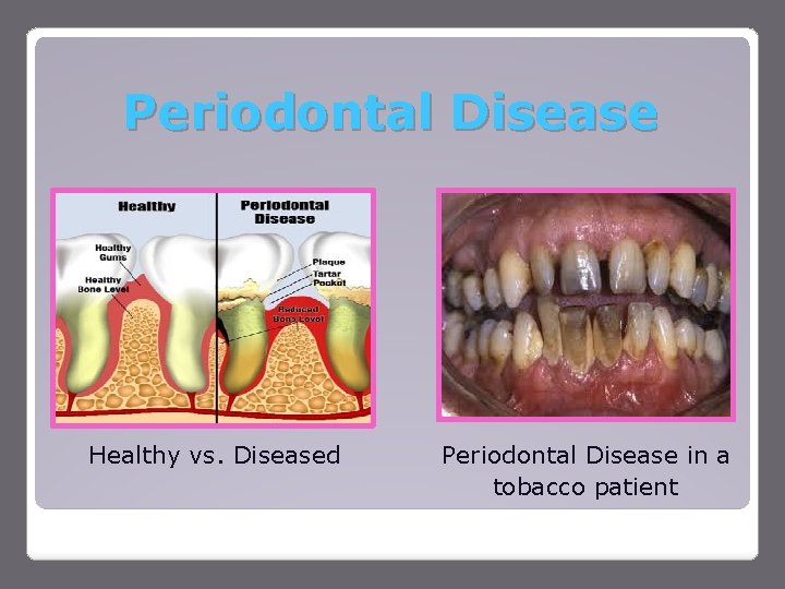 Periodontal Disease Healthy vs. Diseased Periodontal Disease in a tobacco patient 
