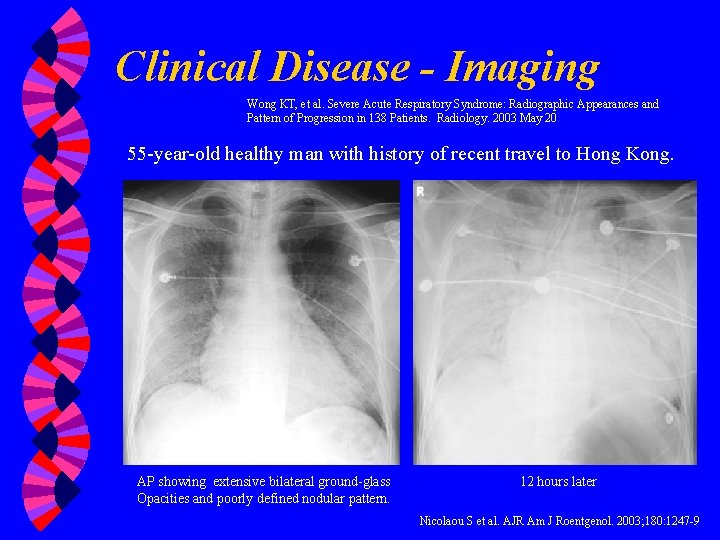 Clinical Disease - Imaging Wong KT, et al. Severe Acute Respiratory Syndrome: Radiographic Appearances