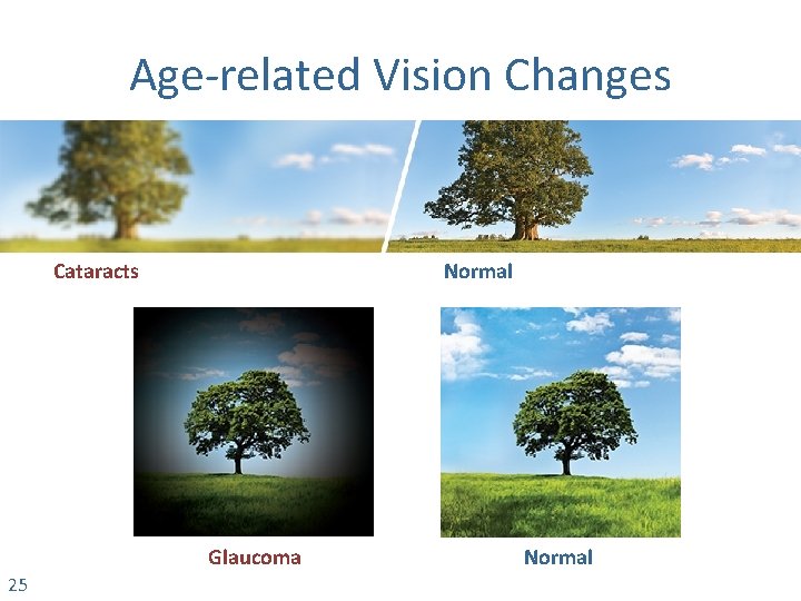Age-related Vision Changes Cataracts Normal Glaucoma 25 Normal 