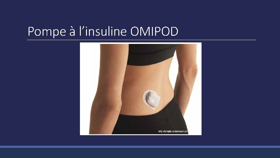 Pompe à l’insuline OMIPOD 