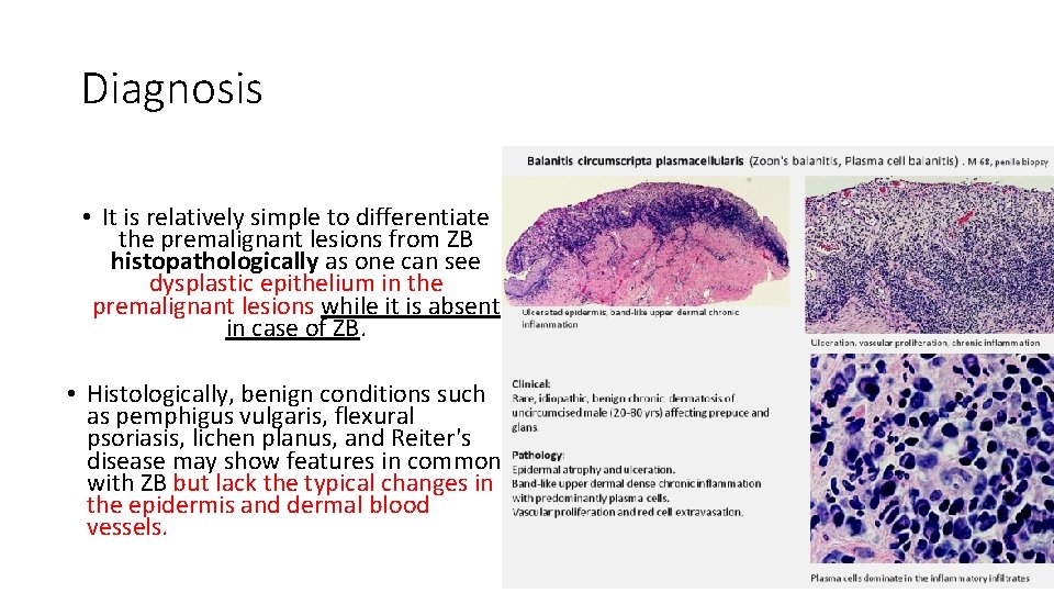 Diagnosis • It is relatively simple to differentiate the premalignant lesions from ZB histopathologically
