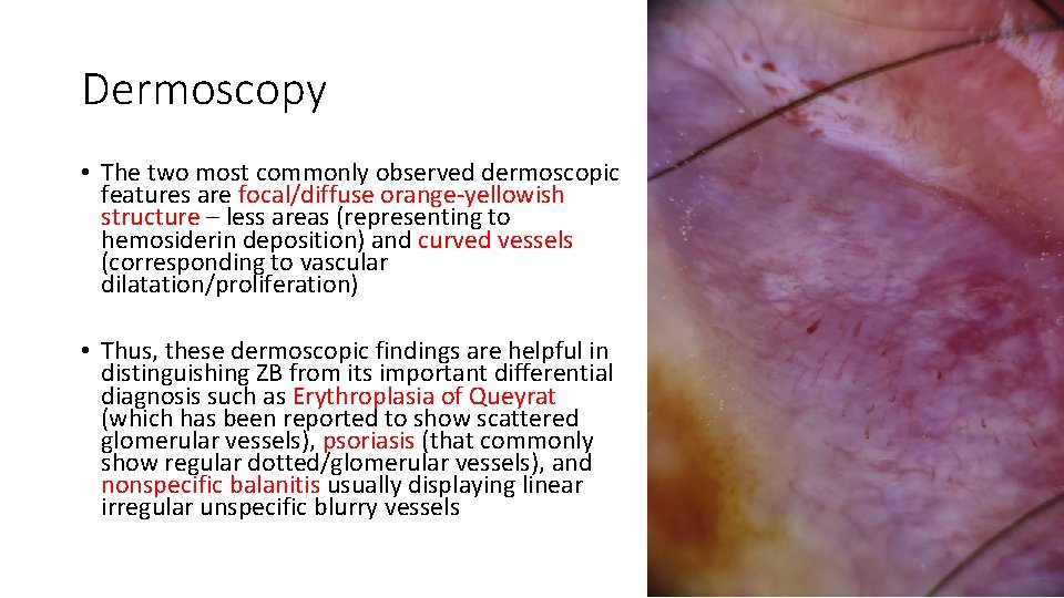 Dermoscopy • The two most commonly observed dermoscopic features are focal/diffuse orange-yellowish structure –